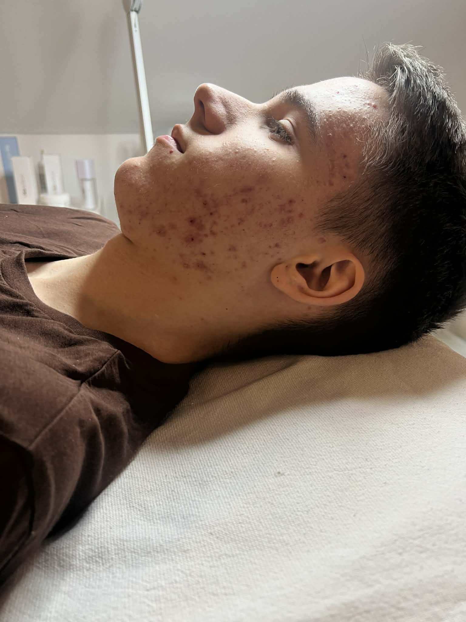 Akné Terápia Hydratouch Kezelés Előtt