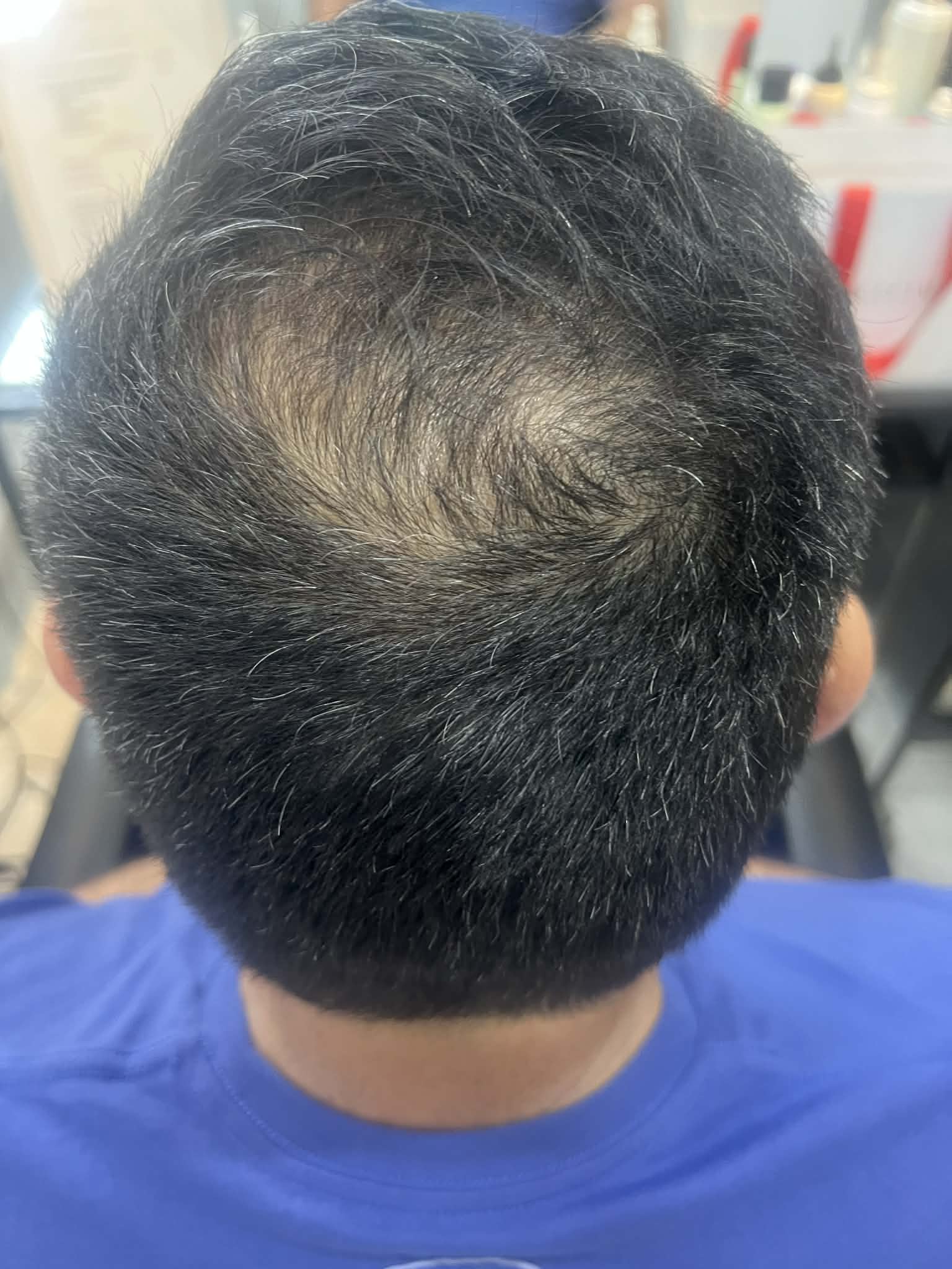 Biopen Hajmezoterápia Kezelés Előtt