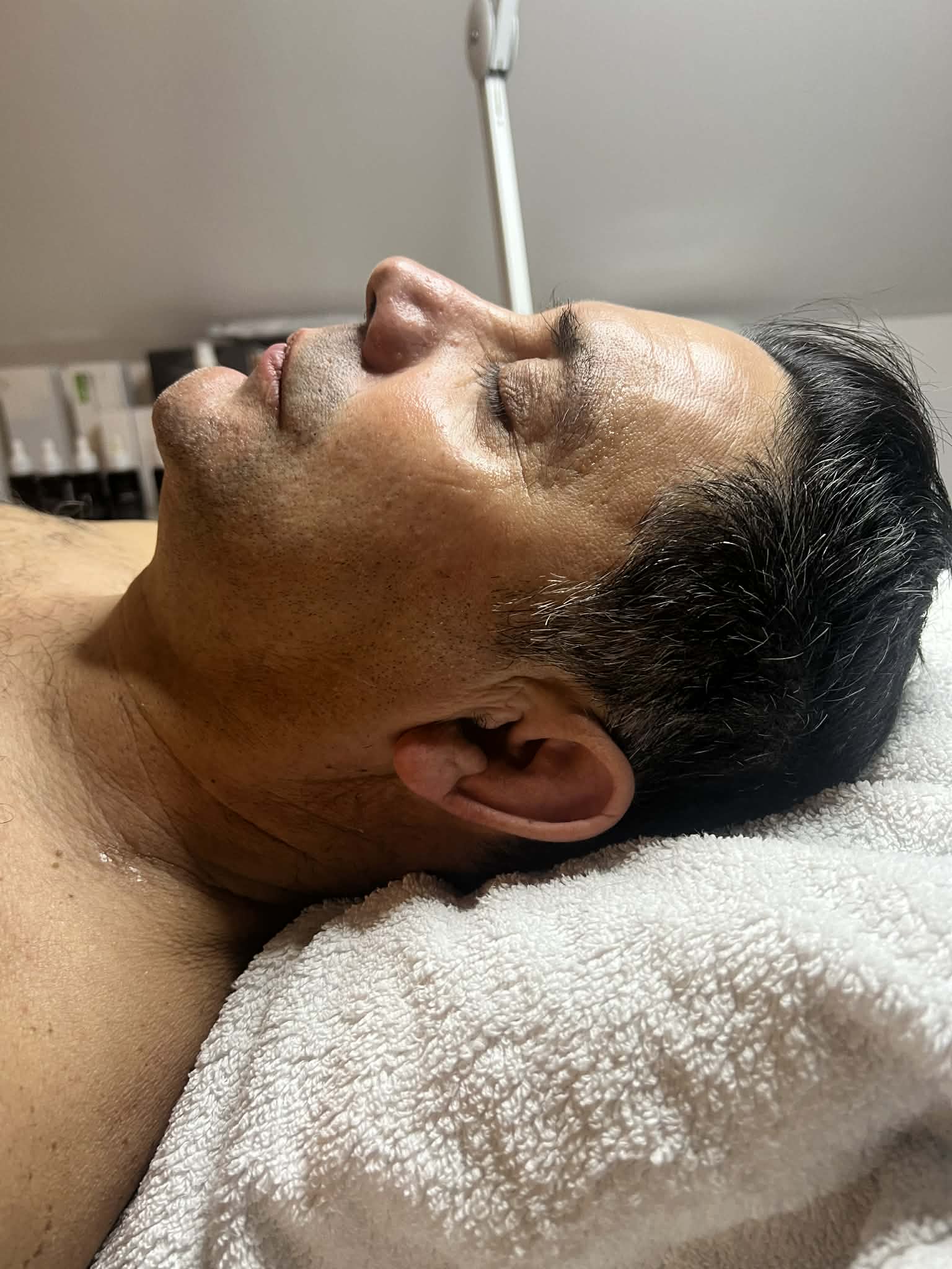 Carboxy Terápia Után