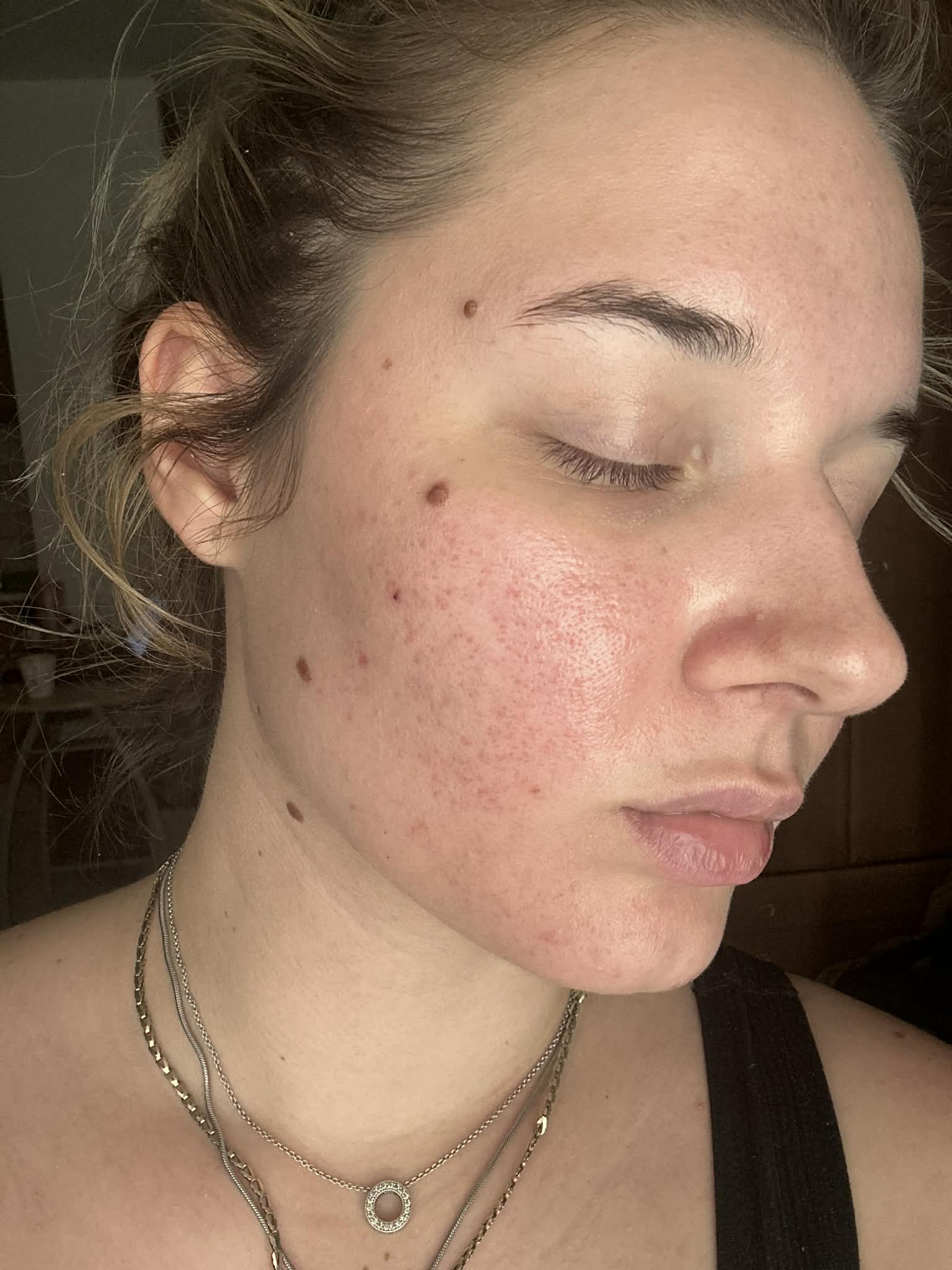 Ekseption Peptid Peel Kezelés Után