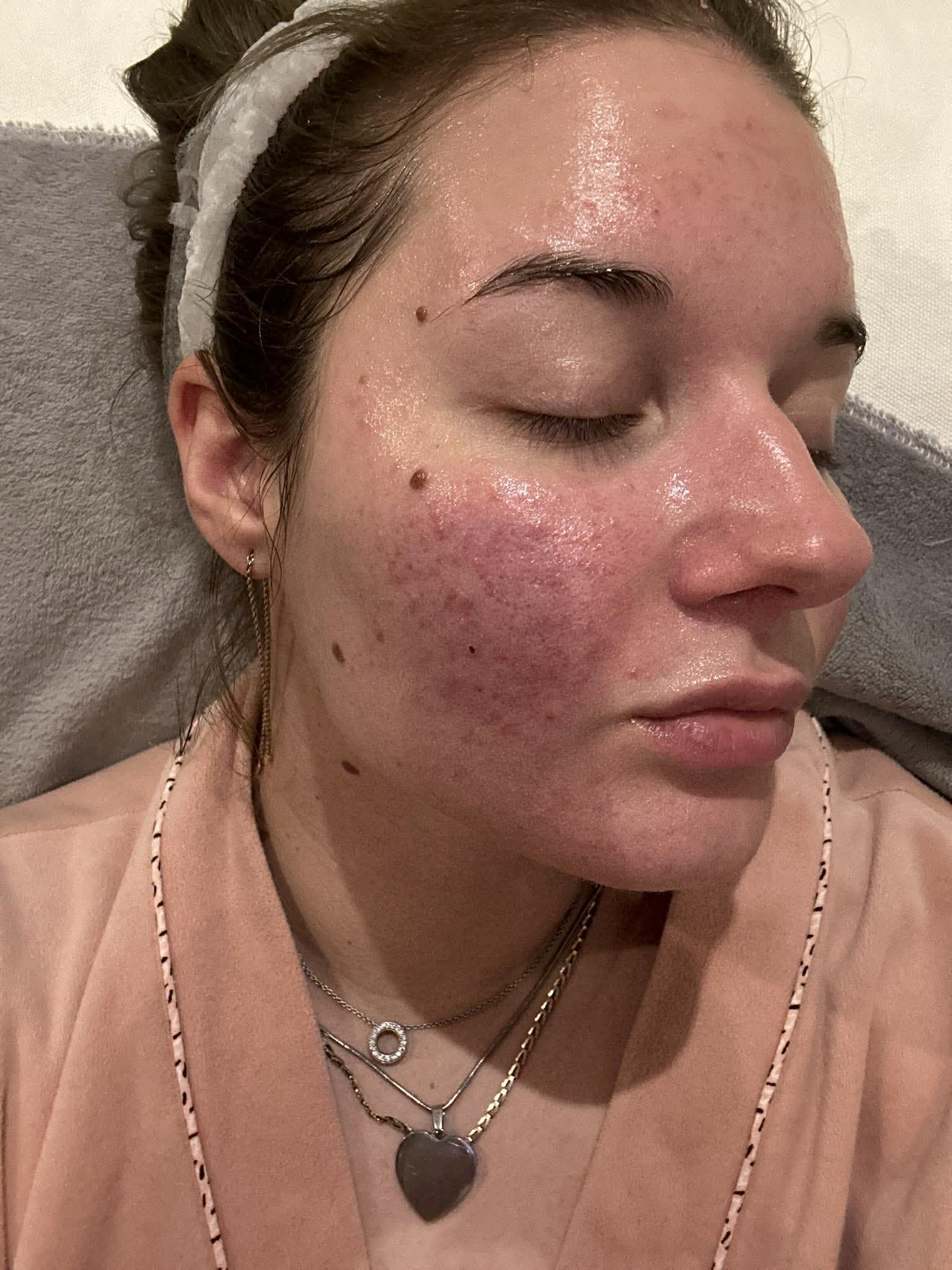 Ekseption Peptid Peel Kezelés Előtt