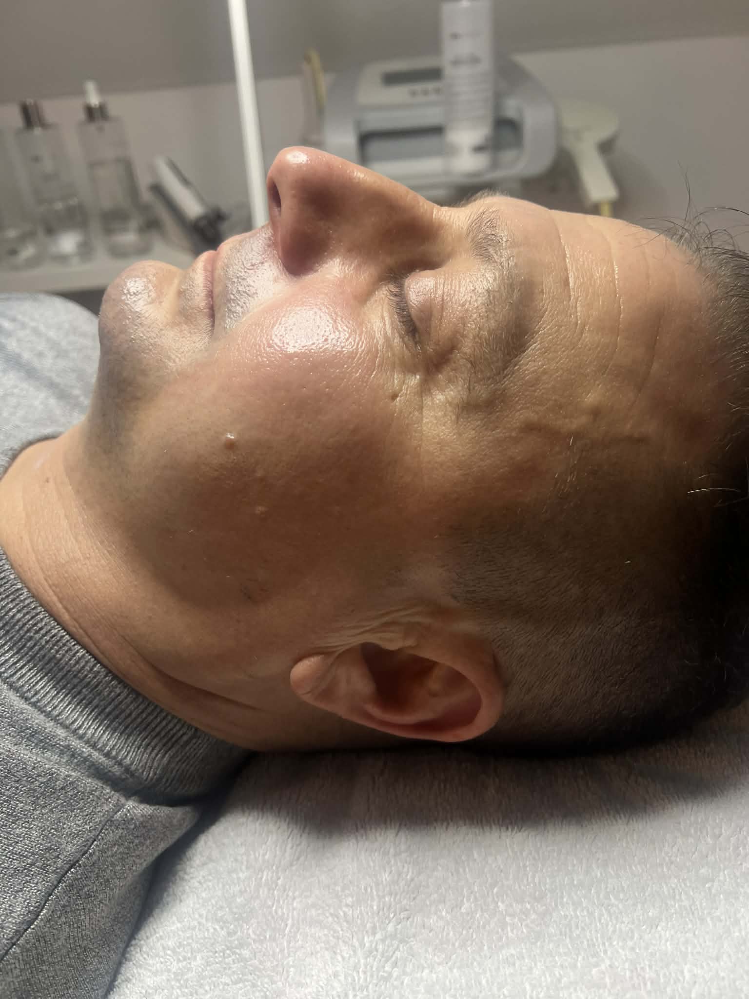 Thermage Kezelés Után