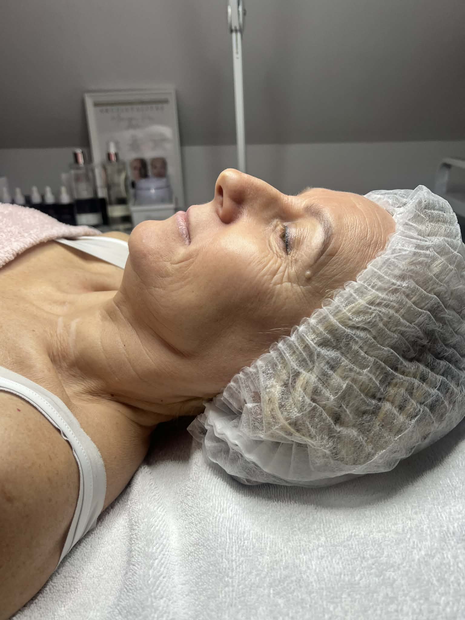 Thermage Kezelés Előtt